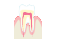 虫歯の進行具合と治療方法